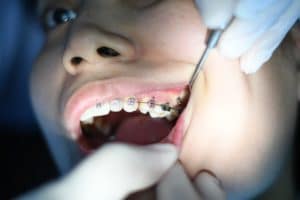 Mâchoire, dents et ATM en chiropraxie - Chiropractie Toulouse